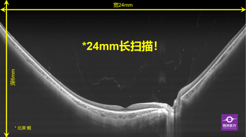 盆腔淤血症最新治疗法研究及进展